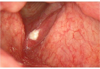 Leukoplakia