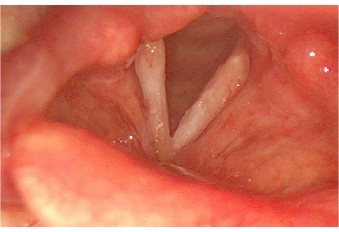 Leukoplakia1